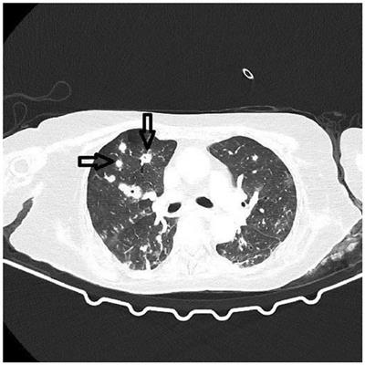 Invasive fungal disease in COVID-19 patients: a single-center prospective observational study